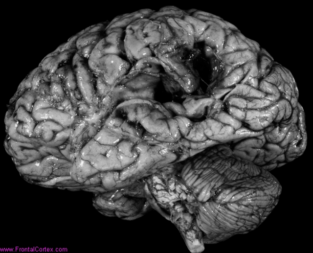 Cavitated infarct, posterior middle cerebral artery circulation